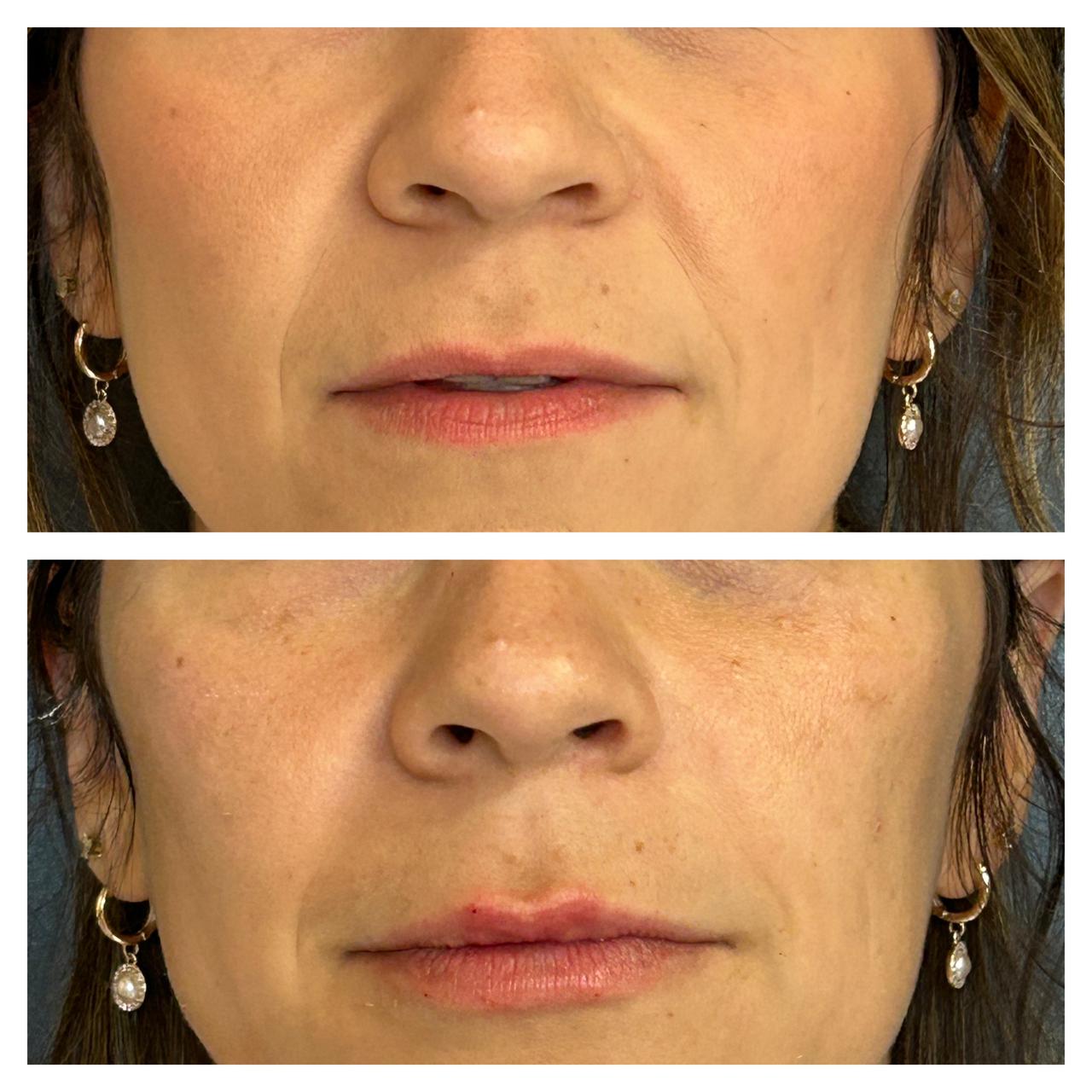 Antes e depois de preenchimento labial