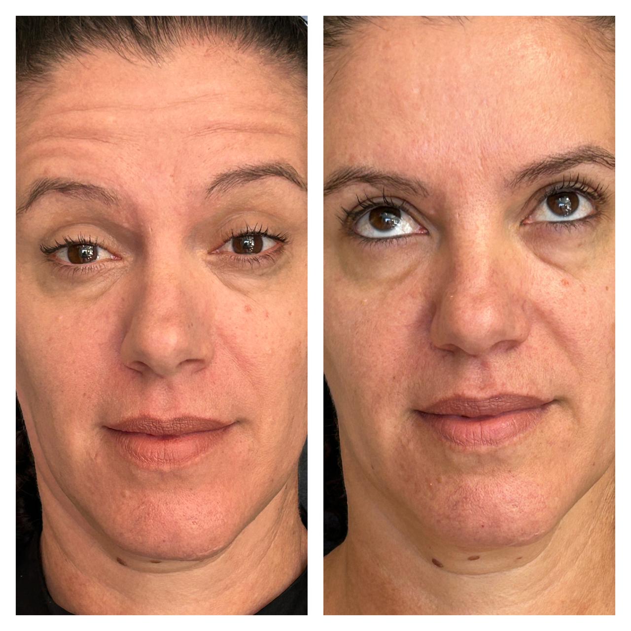 Antes e depois de aplicação de toxina botulínica