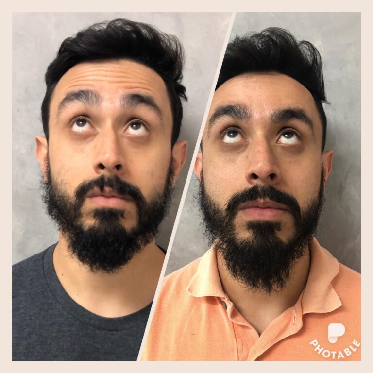 Antes e depois de tratamento com botox na testa de um homem mostrando na parte superior o antes e na inferior do depois